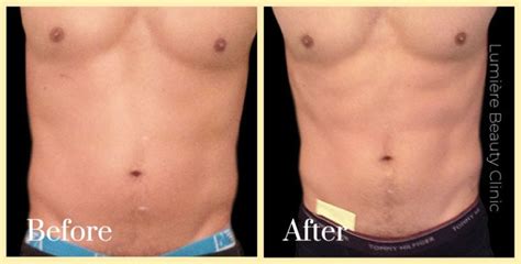 EMSCULPT Body Sculpting Sydney .